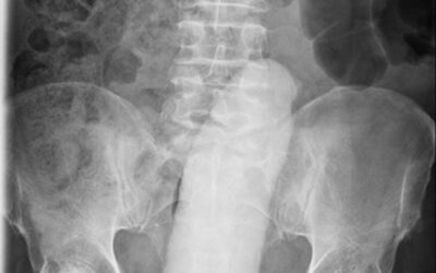 (Notizie) Ragazzo Cinese si fa rimuovere un dildo di 23 cm dopo 5 giorni
