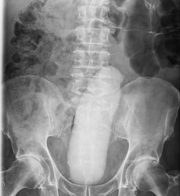 (Notizie) Ragazzo Cinese si fa rimuovere un dildo di 23 cm dopo 5 giorni